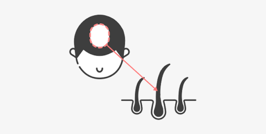 upic semi-permanent-scalp