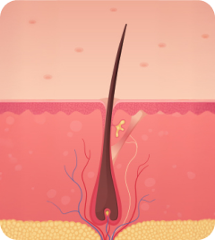 upic semi-permanent-scalp