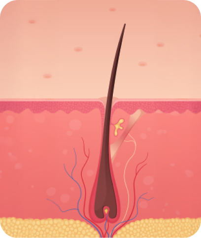 upic semi-permanent-scalp